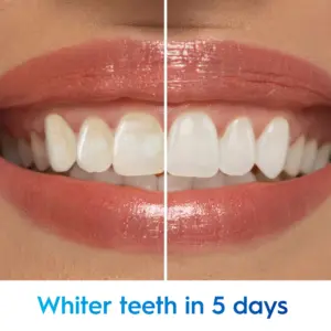 Whitening Toothpaste Whiter Teeth In Just 5 Days